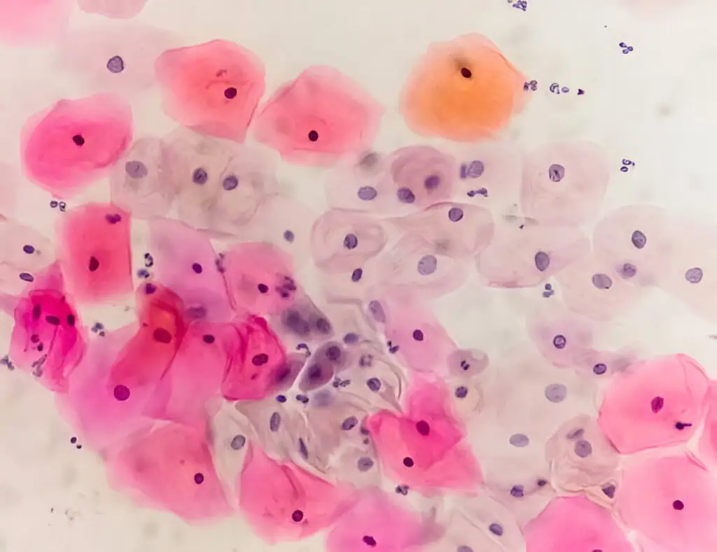 Advancing Diagnostics: From Pap Smears to HPV DNA Testing
