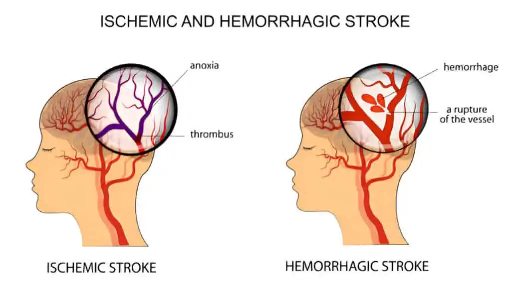 Decoding Stroke Types: A Race Against Time